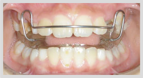 診療時間 平日 10 00 13 00 15 30 19 00 土曜 10 00 12 00 14 00 18 00 休診日 木曜日 日曜日 祝日 Device 矯正装置について マルチブラケット装置 永久歯列の治療に使用します ブラケットにはシルバーの金属製のものや 透明で目立たない